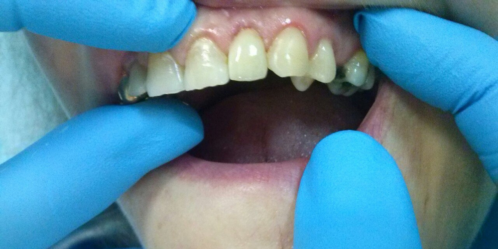  Протезирование зуба с помощью одиночной коронки из диоксида циркония Prettau