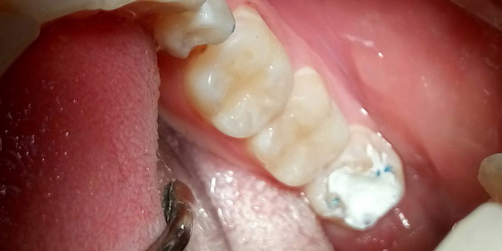  Лечение глубокого кариеса двух зубов
