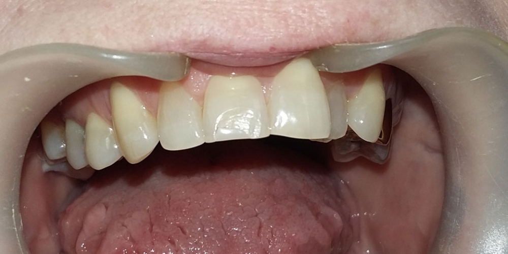 Первое фото - до начала лечения. Реставрация скола переднего зуба