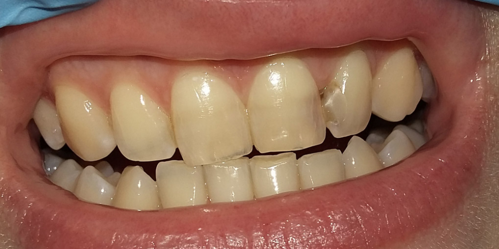  Эстетическая реставрация двух передних зубов