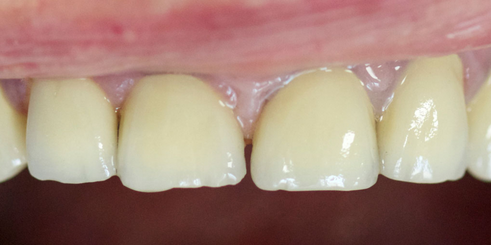  Восстановление всех зубов композитным материалом, изготовление и установка металлокерамических корон