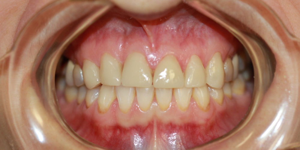  Керамические (безметалловые) виниры Е-МАХ на 6 передних зубов
