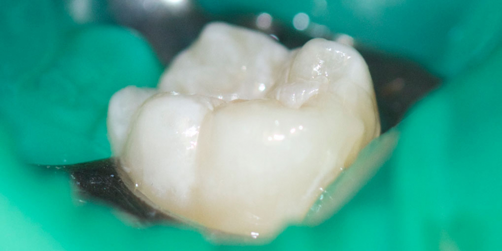  Лечение кариозного процесса на жевательном зубе нижней челюсти