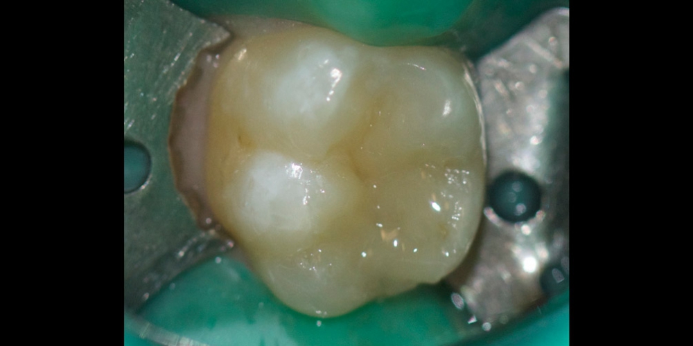  Лечение среднего кариеса на жевательном зубе + реставрация