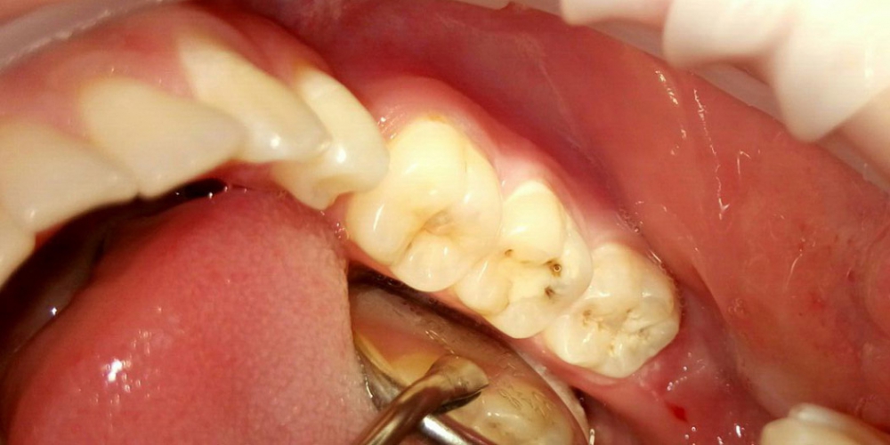 Лечение глубокого кариеса двух зубов