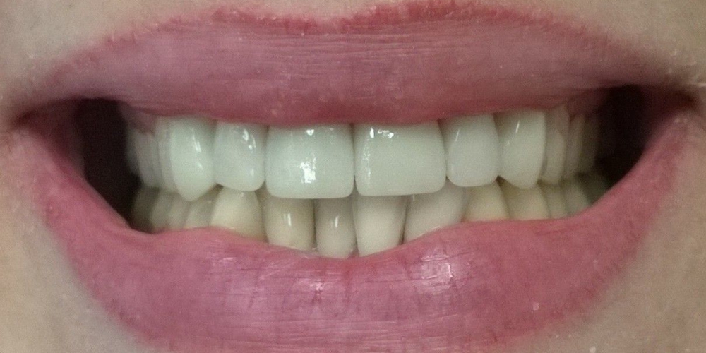  Керамические (безметалловые) коронки E-Max (6 верхних зубов)