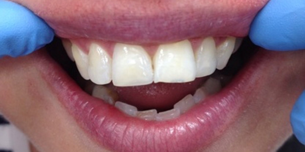  Отбеливание зубов Zoom AP с последующей реставрацией переднего зуба