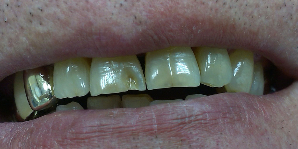 Результат реставрации скола режущего края зуба композитом