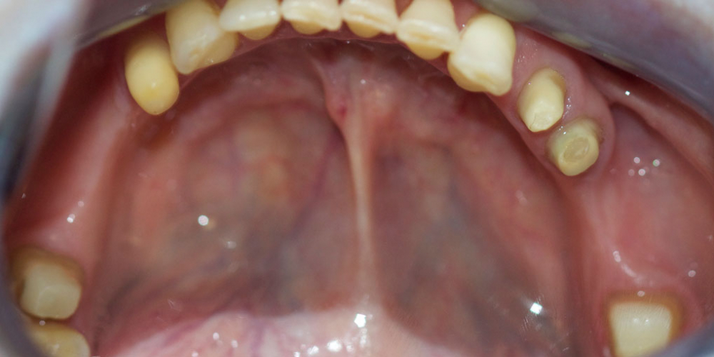  Восстановление жевательной функции зубов на нижней челюсти мостовидными протезами
