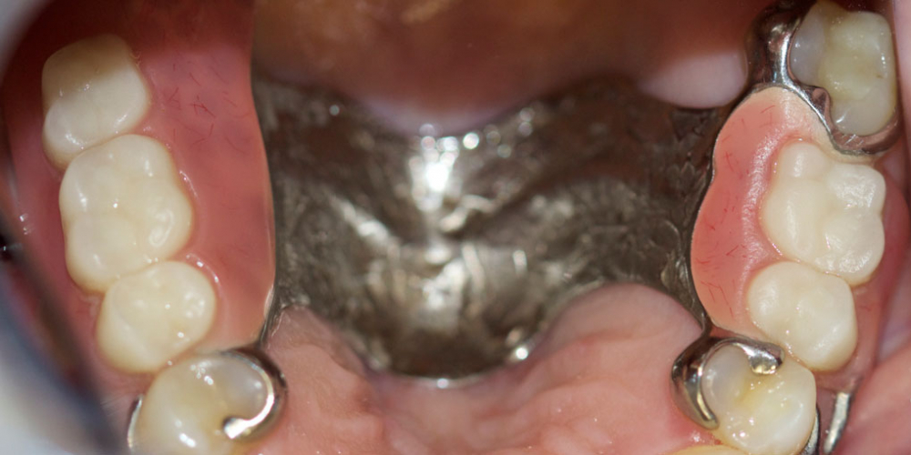  Восстановление жевательной функции зубов на нижней челюсти бюгельными протезами
