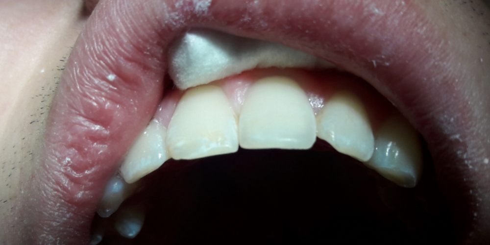  Восстановление режущего края переднего зуба