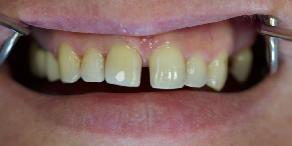  Неудовлетворенность реставрацией на переднем центральном зубе