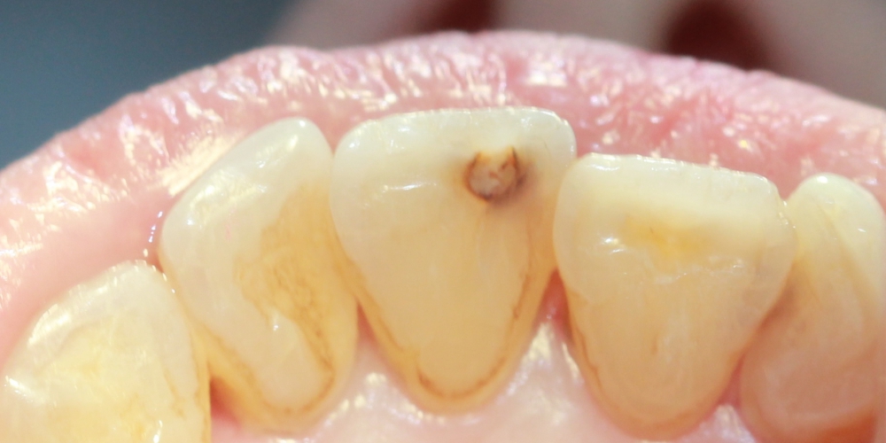  Лечение кариеса переднего зуба (центральный резец)