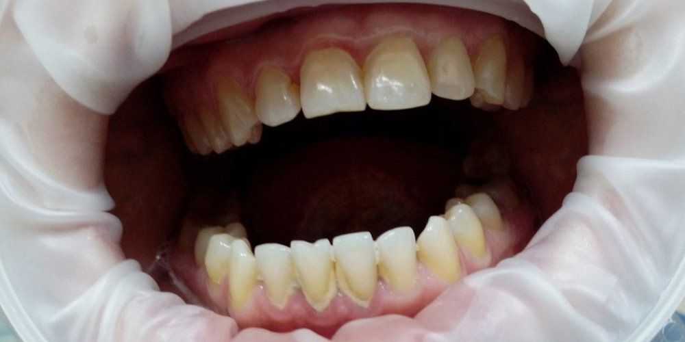  Результат снятия зубного камня ультразвуком