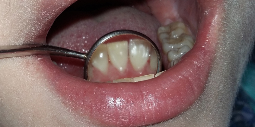  Чистка зубного налета и снятие зубного камня