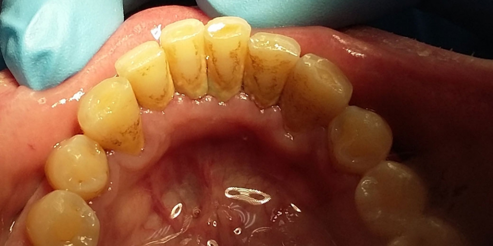 Нижняя челюсть фото до профессиональной чистки зубов. Результат профессиональной гигиены полости рта