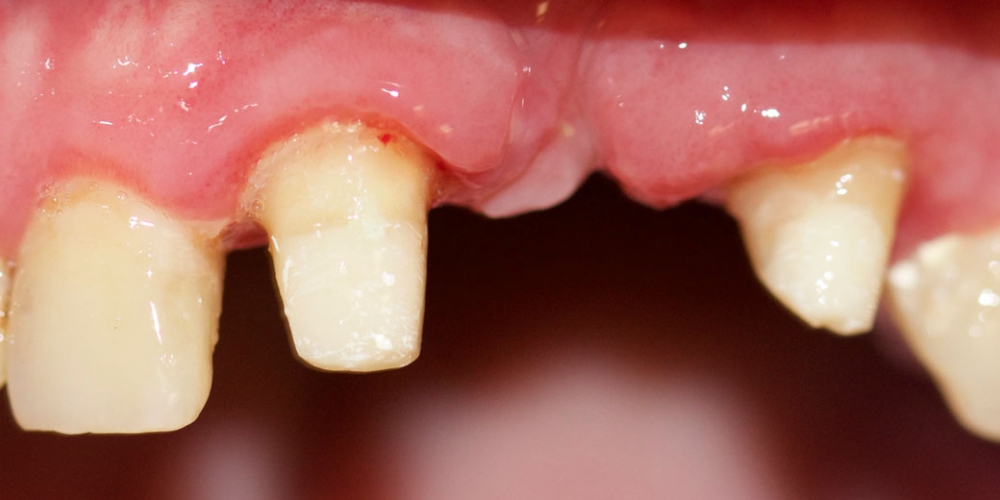  Мостовидный металлокерамический протез на передние зубы
