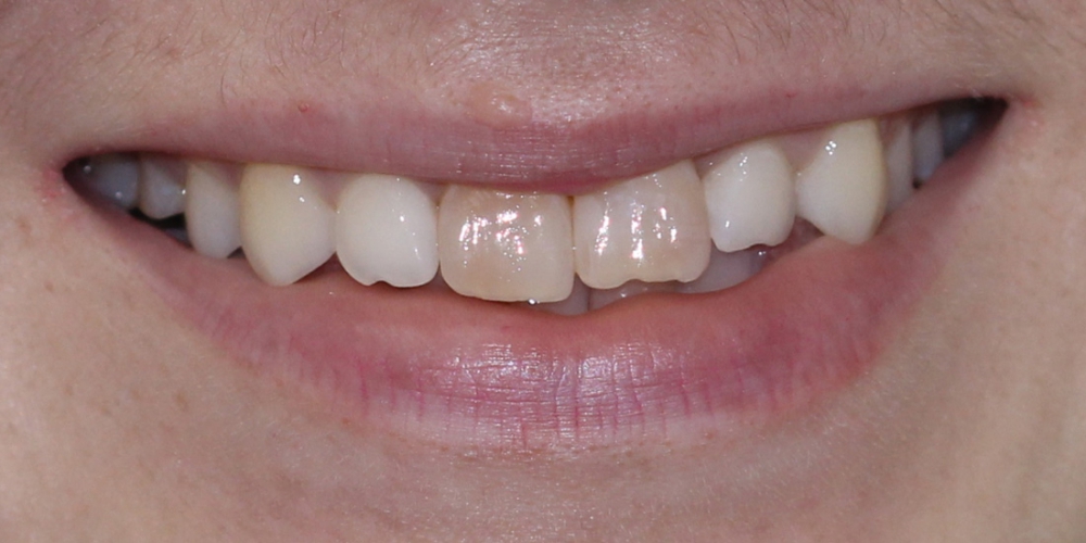  Установка двух керамических виниров на передние зубы
