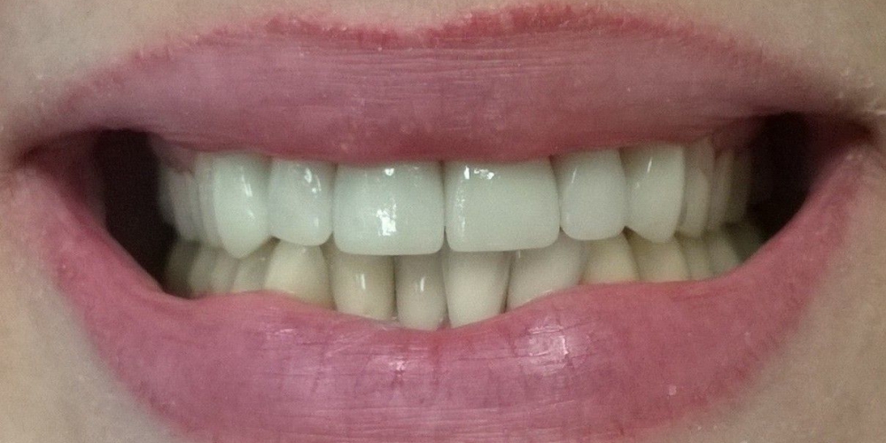 После установки коронок Протезирование передних зубов цельнокерамические коронки E-Max