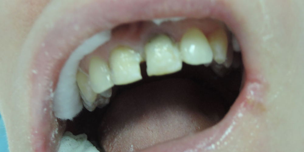  Реставрация 2 зубов светоотверждаемыми композитами