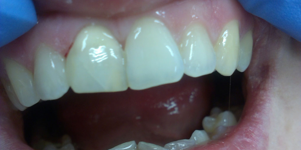 В 3-е посещение старые реставрации в зубах 1.1 и 1.2 были заменены на новые. В результате ткани зуба максимально сохранены! Внутриканальное отбеливание переднего зуба Opalescense Endo