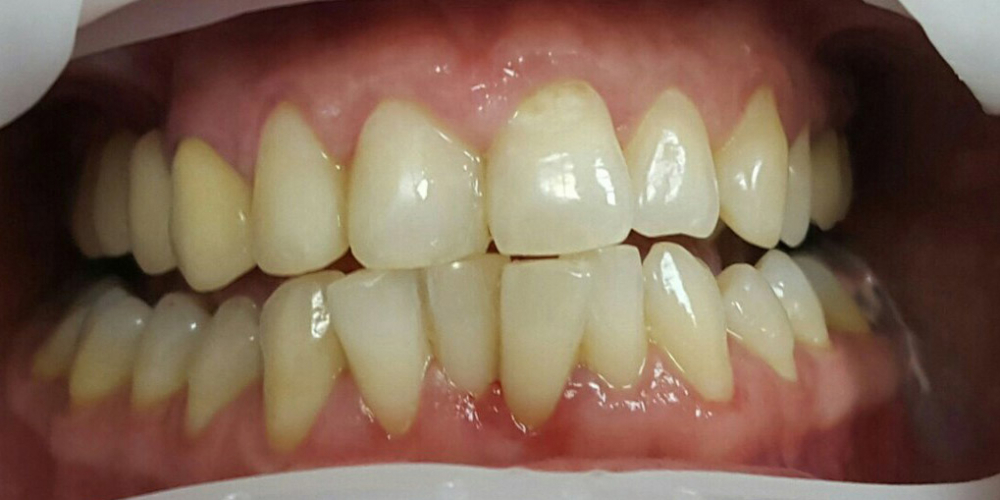  Лечение кариеса и реставрация двух передних зубов