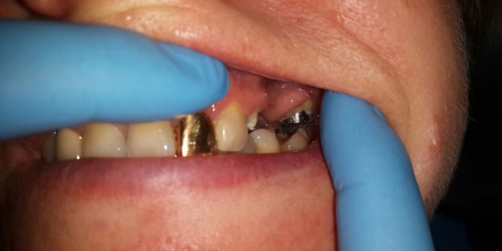  Мостовидный протез из металлокерамики, восстановление 2 зубов