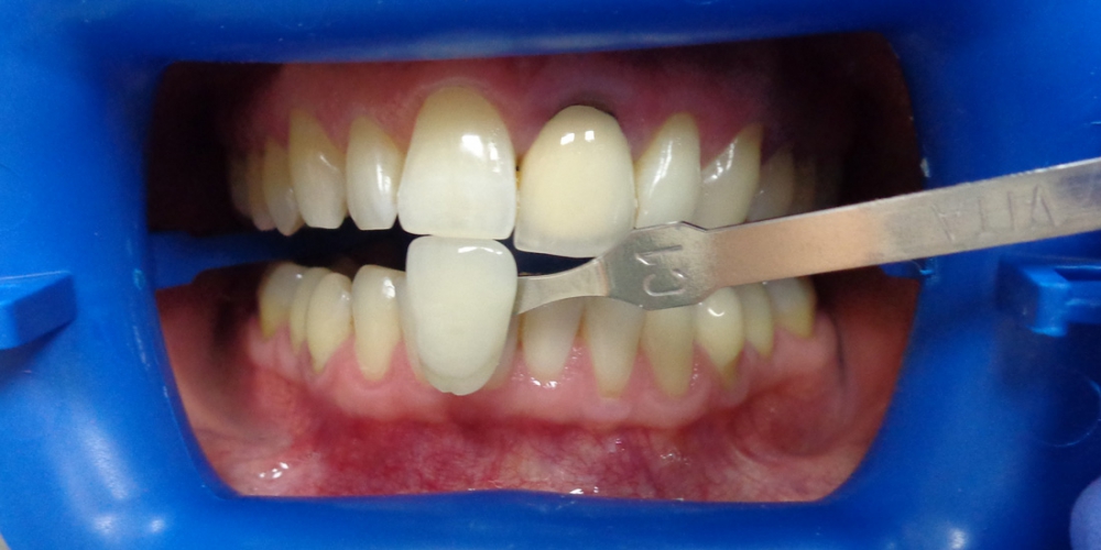 На фотографии показан цвет зубов до процедуры отбеливания. Отбеливание зубов лампой Zoom