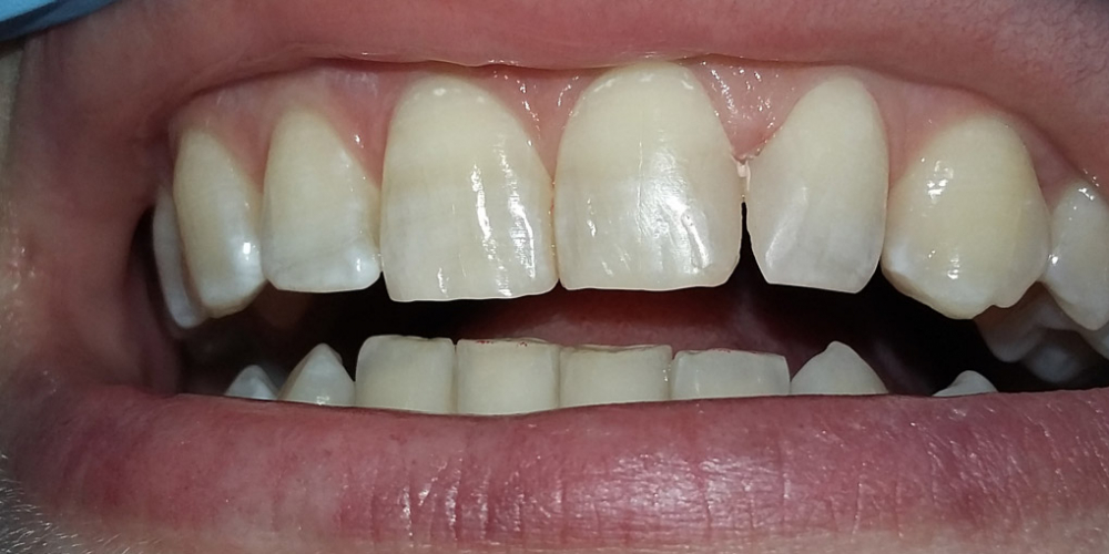  Эстетическая реставрация двух передних зубов