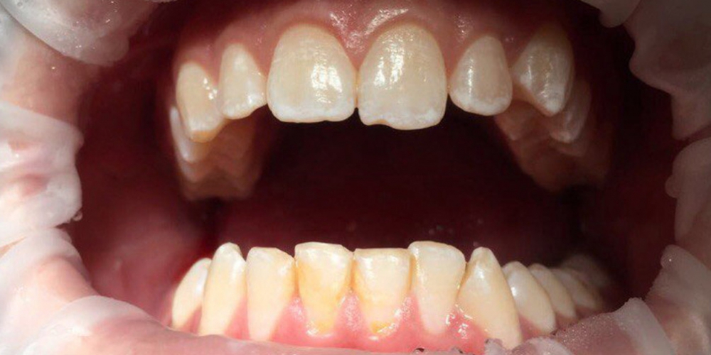  Профессиональная гигиена всей полости рта с последующей полировкой и реминерализацией