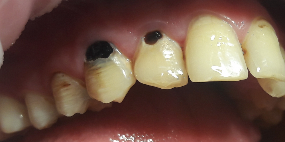  Реставрация фронтальных зубов, пораженных множественным кариесом