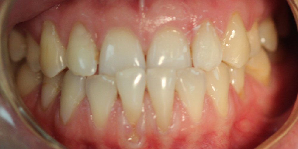  Исправление прикуса зубов на аппаратах съемного типа