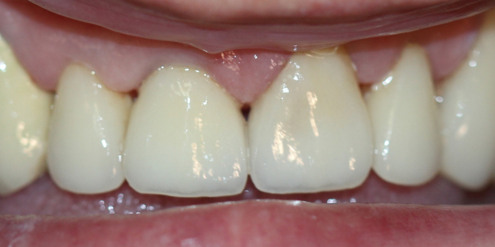  Безметалловая керамика E-max на передние зубы