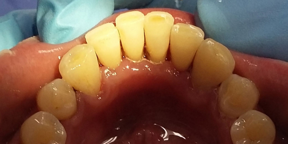Нижняя челюсть фото после профессиональной чистки зубов. Результат профессиональной гигиены полости рта