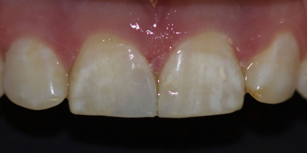  Ремонт скола центрального зуба верхней челюсти