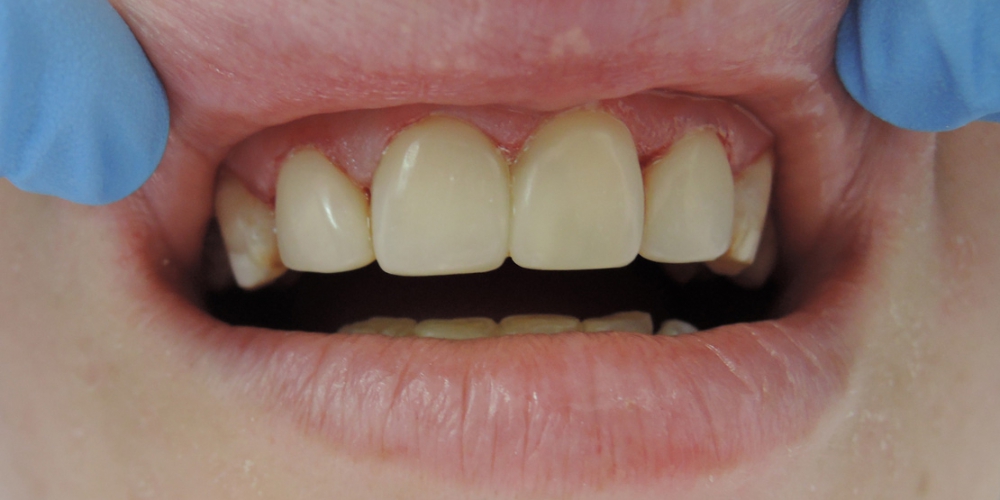  Виниры на 4 передних верхних зуба
