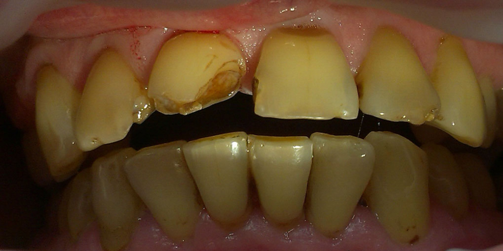  Художественная реставрация передних зубов