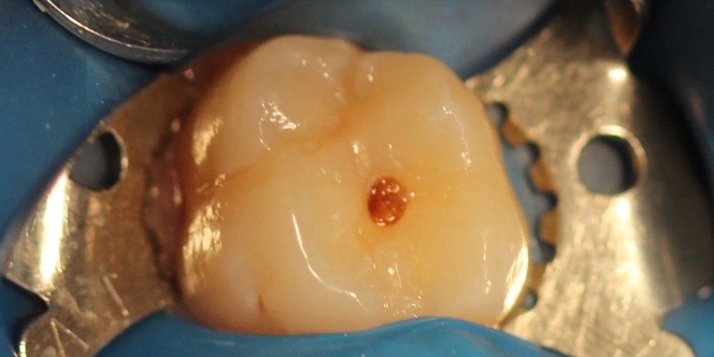 Лечение кариеса жевательного зуба материалом Харизма, Германия