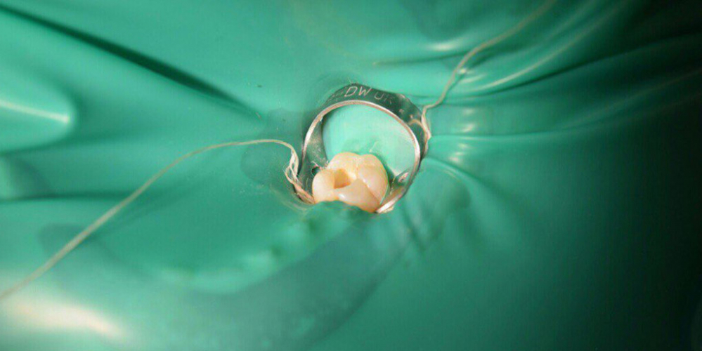  Лечение глубокого кариеса жевательного зуба