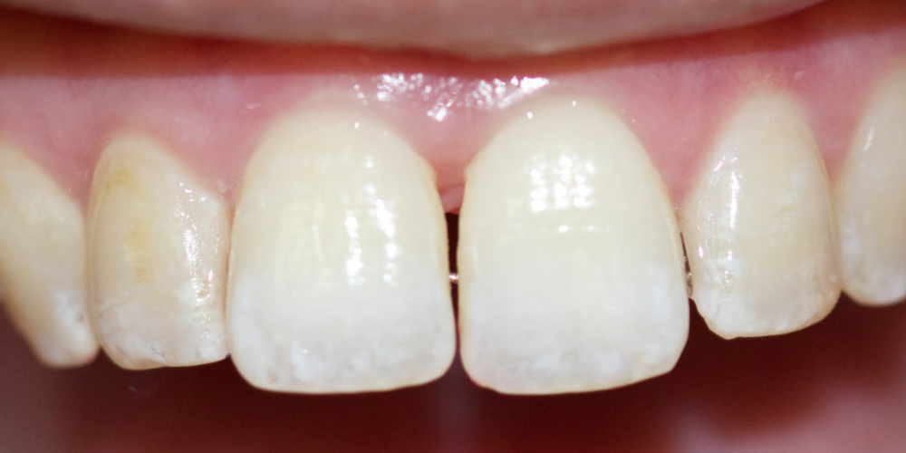  Устранение щели между зубами съемными аппаратами