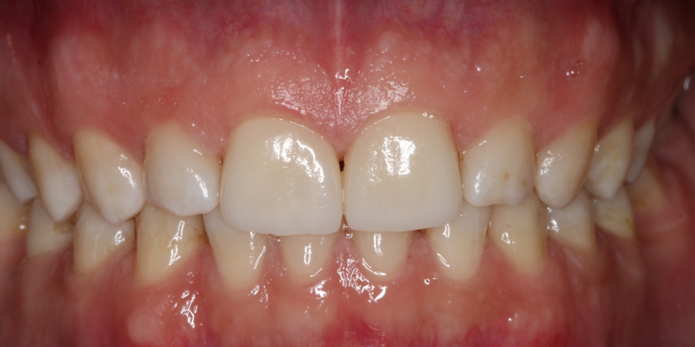  Реставрация керамическими винирами E-max (двух верхних и нижних зубов)