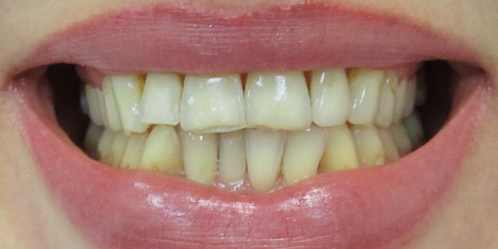  Керамические (безметалловые) коронки E-Max (6 верхних зубов)