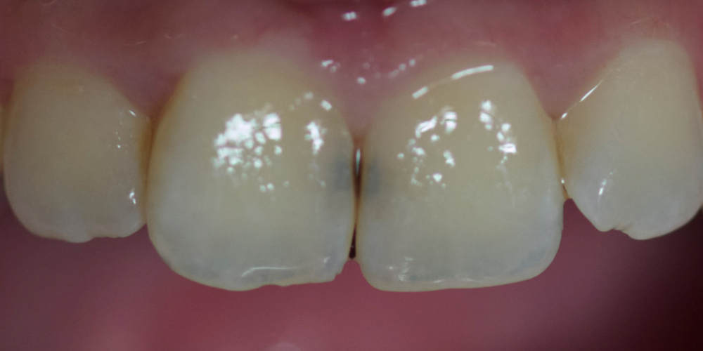  Лечение зубов и эстетическая реставрация, реакция на холод