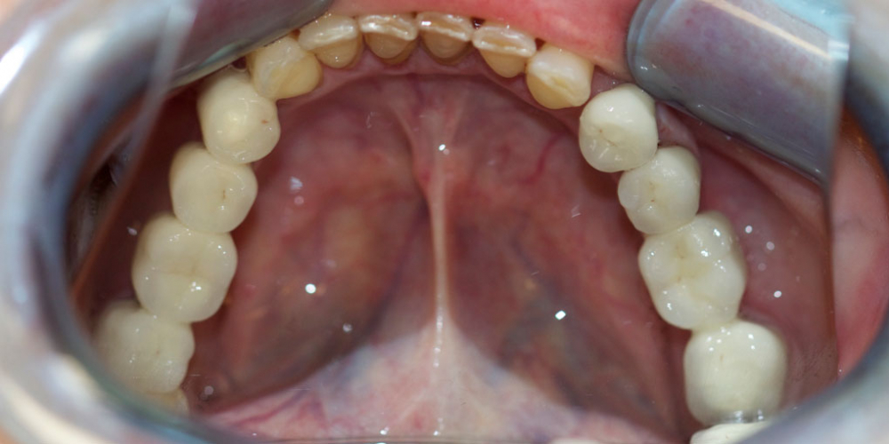  Восстановление жевательной функции зубов на нижней челюсти мостовидными протезами
