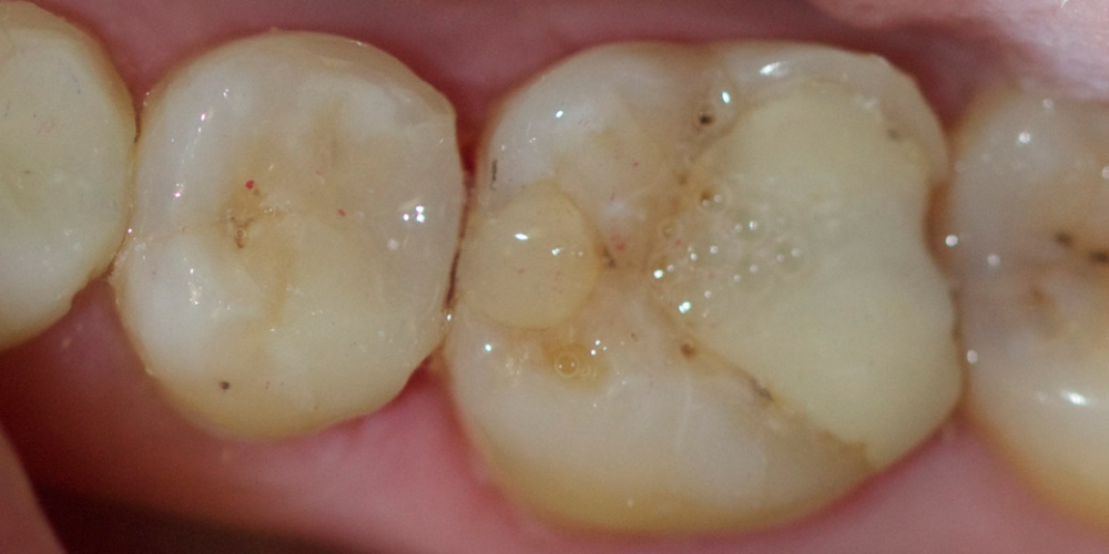  Лечение среднего кариеса на жевательном зубе нижней челюсти