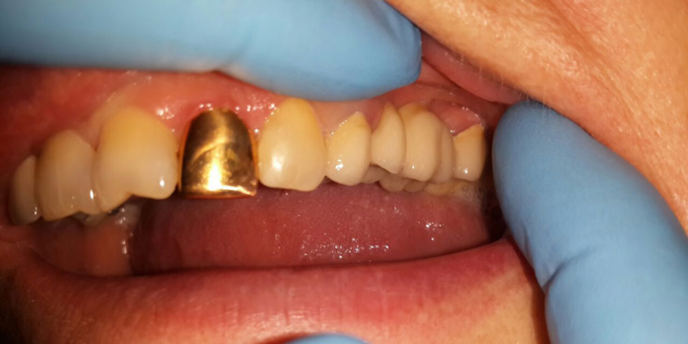  Мостовидный протез из металлокерамики, восстановление 2 зубов