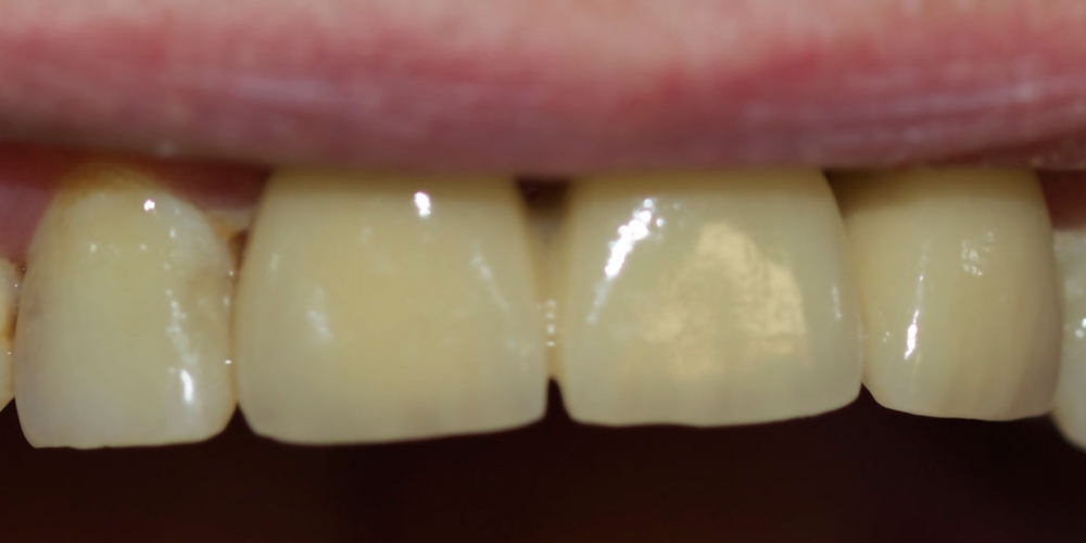  Мостовидный металлокерамический протез на передние зубы