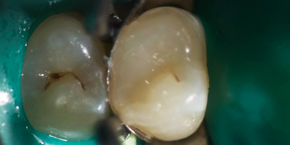  Лечение зуба под анастезией с применением коффердама