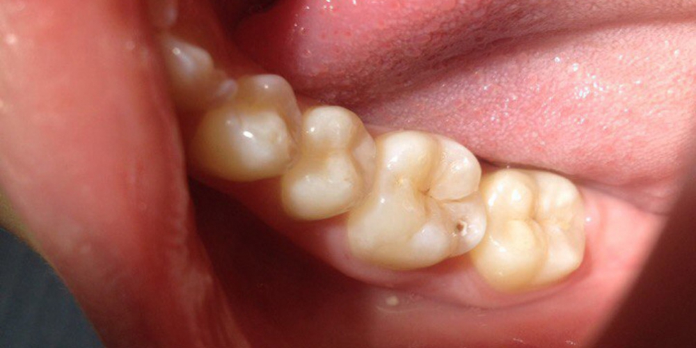 Фото поверхностного кариеса жевательного зуба Результат лечения поверхностного кариеса жевательного зуба