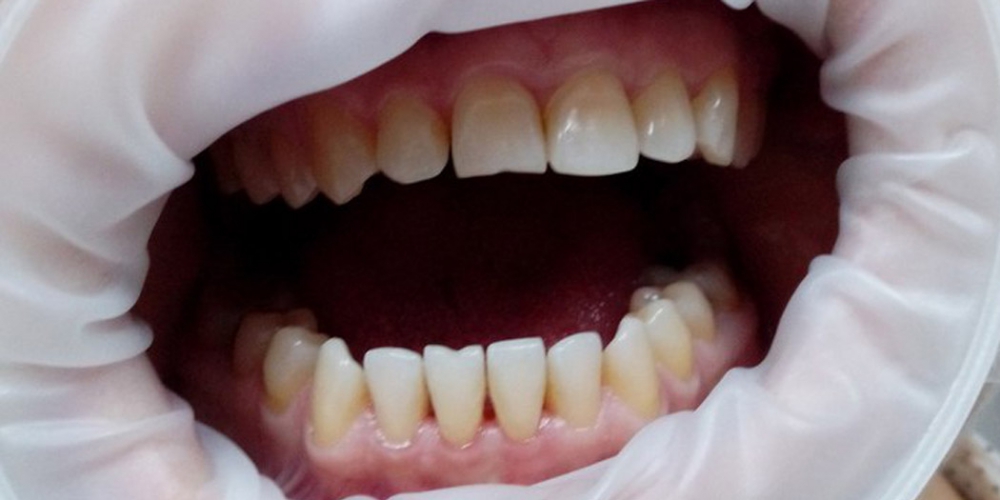  Результат снятия зубного камня ультразвуком